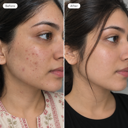 Azelaic acid serum to help improve the appearance of dark spots and post-acne marks.